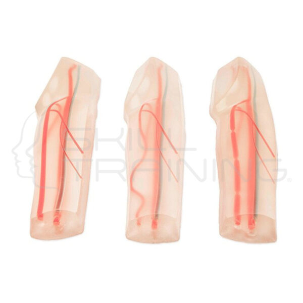 Ultrasonido avanzado de escleroterapia - Imagen 1