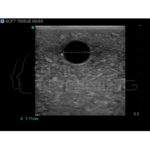 Modelo de entrenamiento de ultrasonido de biopsia de mama - Imagen 3