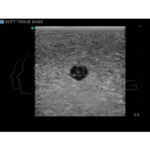 Modelo de entrenamiento de ultrasonido de biopsia de mama - Imagen 4