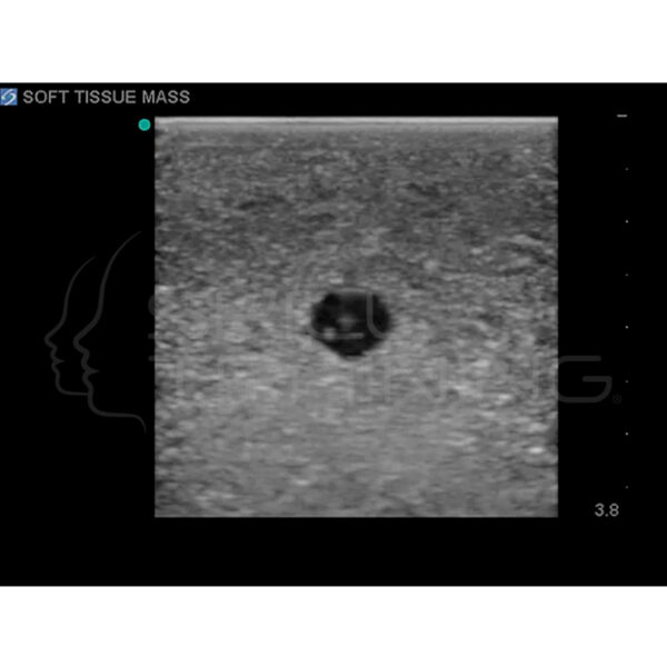 Modelo de entrenamiento de ultrasonido de biopsia de mama - Imagen 4