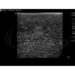 Modelo de entrenamiento de ultrasonido de biopsia de mama - Imagen 6