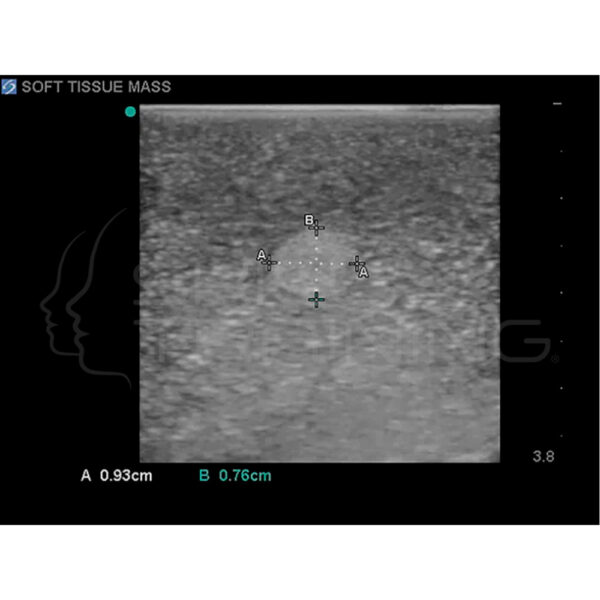 Modelo de entrenamiento de ultrasonido de biopsia de mama - Imagen 7