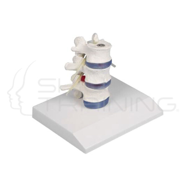 Vértebras lumbares con disco intervertebral prolapsado - Imagen 1