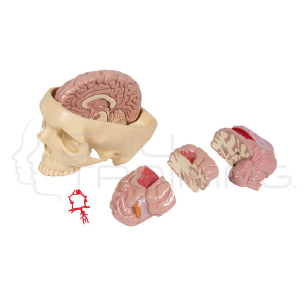 Enfermedades del cerebro - Imagen 1