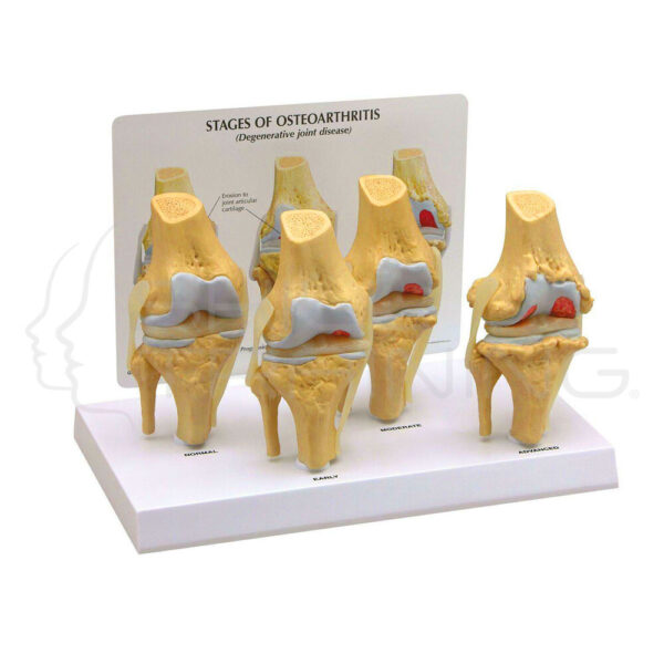Etapa osteoartritis rodilla - Imagen 1