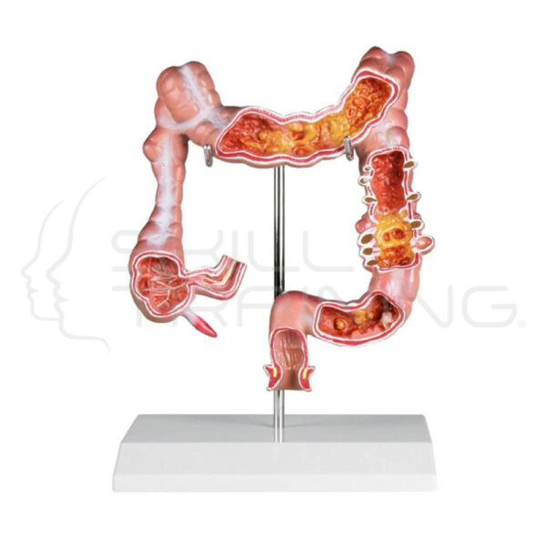 Colon Model with Diseases - Imagen 1