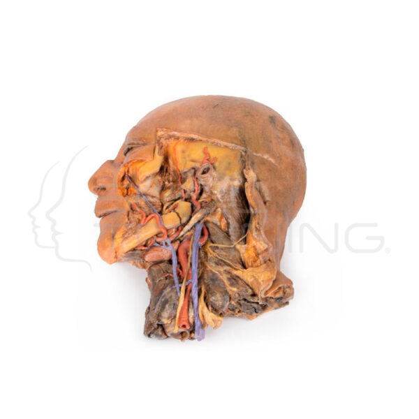 Seccion Sagital de Cabeza y Cuello con Diseccion de la Fosa Infratemporal - Imagen 1