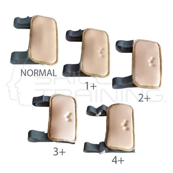 Pitting Edema Model - Imagen 1