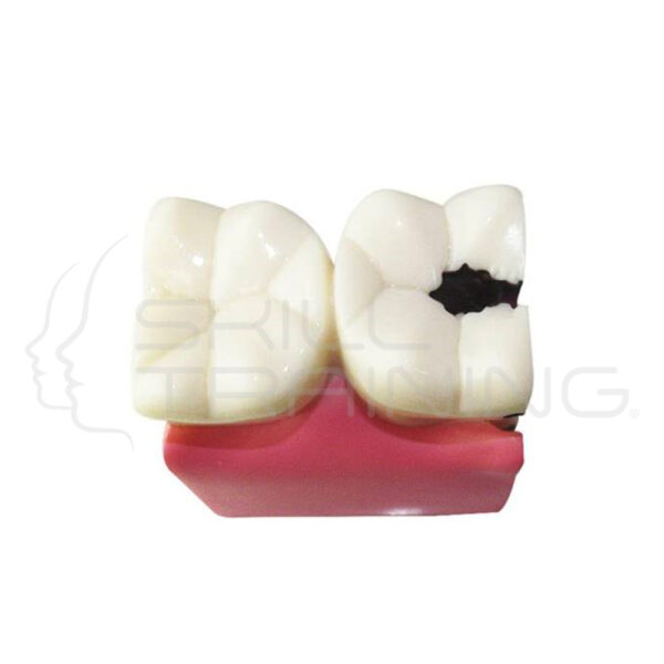 Caries Tooth Models (nissin Compartible - A27a-46f) - Imagen 1