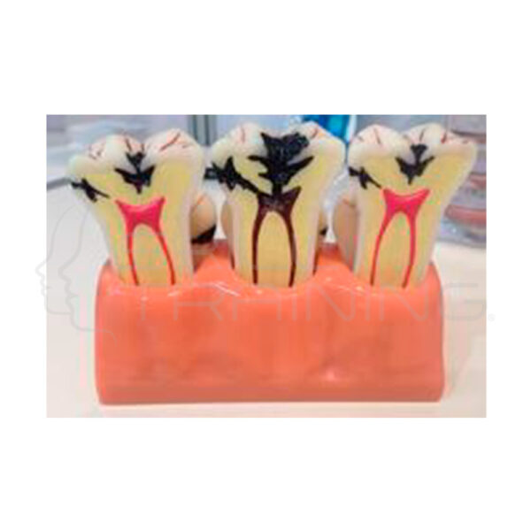 Modelo Desmontado de Caries de 4 Veces el Tamano Normal - Imagen 1
