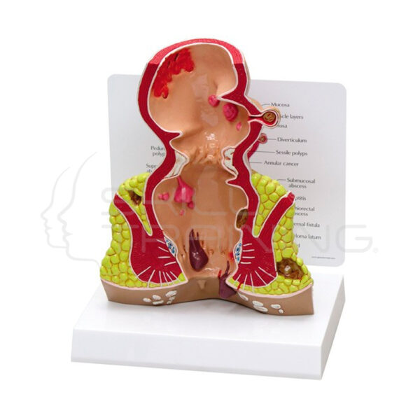 Modelo Anatomico de Recto con Patologias - Imagen 1