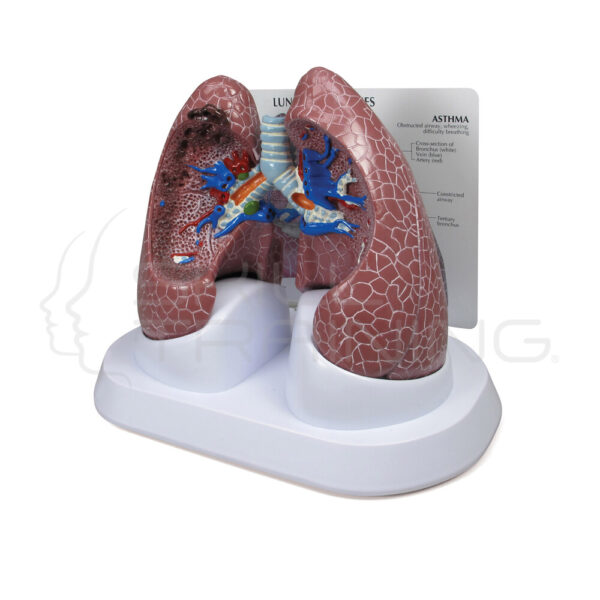 Set de Pulmones con Patologías - Imagen 1