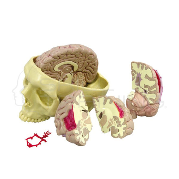 Craneo con Cerebro de Tamano Natural con Patologias - Imagen 1