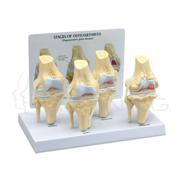 Artrosis de Rodilla de 4 Etapas - Imagen 1