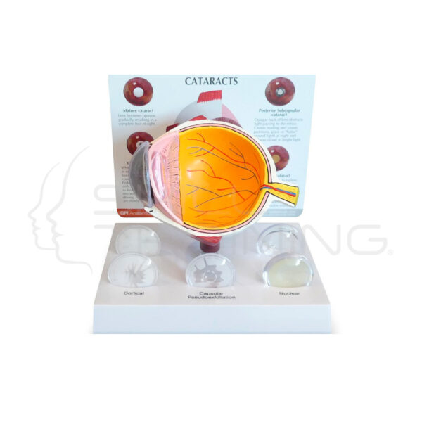 Modelo de Ojo con Catarata - Imagen 1