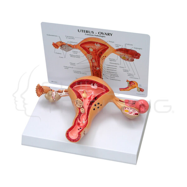 Útero con Patologia Benigna y Maligna - Imagen 1
