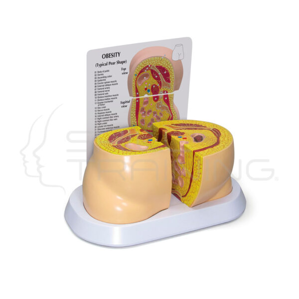 Modelo Anatomico de Obesidad - Imagen 1