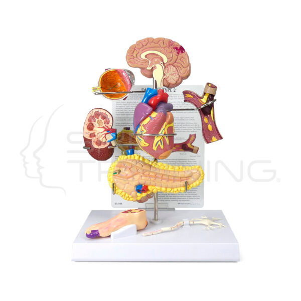 Modelo de Diabetes Tipo 2 - Imagen 1