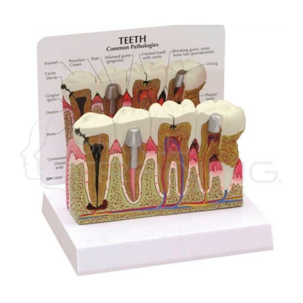 Modelo Anatomico de Dientes y Encias Enfermas - Imagen 1