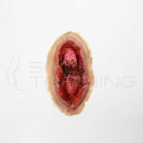 Fractura Expuesta - Moulage - Imagen 1
