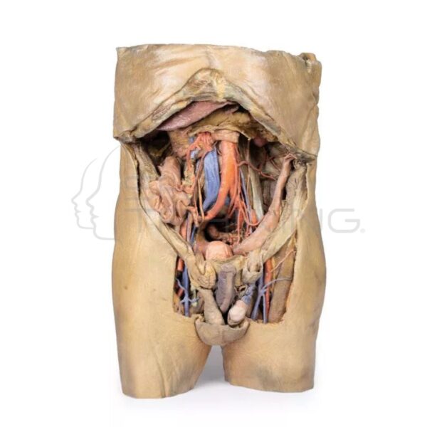 Modelo 3d Abdomen con Hernias Bilaterales - Imagen 1